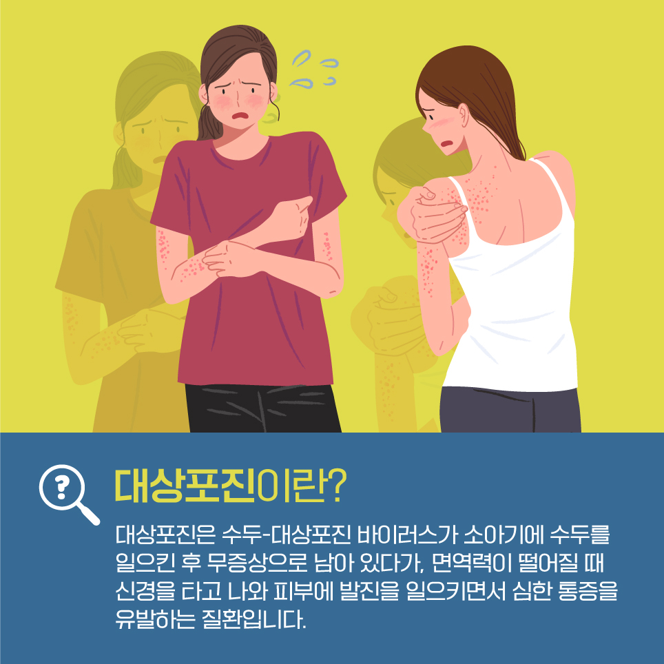 대상포진은 수두-대상포진 바이러스가 소아기에 수두를 일으킨 후 무증상으로 남아 있다가, 면역력이 떨어질 때 신경을 타고 나와 피부에 발진을 일으키면서 심한 통증을 유발하는 질환입니다.